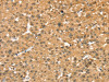 The image on the left is immunohistochemistry of paraffin-embedded Human liver cancer tissue using CSB-PA141242 (RASSF9 Antibody) at dilution 1/40, on the right is treated with fusion protein. (Original magnification: ×200)