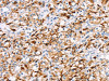 The image on the left is immunohistochemistry of paraffin-embedded Human prostate cancer tissue using CSB-PA903114 (RDH11 Antibody) at dilution 1/20, on the right is treated with fusion protein. (Original magnification: ×200)