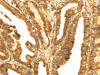 The image on the left is immunohistochemistry of paraffin-embedded Human esophagus cancer tissue using CSB-PA779772 (RLN1 Antibody) at dilution 1/20, on the right is treated with fusion protein. (Original magnification: ×200)