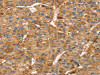 The image on the left is immunohistochemistry of paraffin-embedded Human liver cancer tissue using CSB-PA084430 (RFFL Antibody) at dilution 1/20, on the right is treated with fusion protein. (Original magnification: ×200)