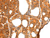 The image on the left is immunohistochemistry of paraffin-embedded Human thyroid cancer tissue using CSB-PA782441 (RGS5 Antibody) at dilution 1/25, on the right is treated with fusion protein. (Original magnification: ×200)