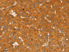 The image on the left is immunohistochemistry of paraffin-embedded Human liver cancer tissue using CSB-PA449923 (RGS4 Antibody) at dilution 1/25, on the right is treated with fusion protein. (Original magnification: ×200)