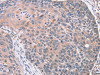 The image on the left is immunohistochemistry of paraffin-embedded Human esophagus cancer tissue using CSB-PA053220 (RGS10 Antibody) at dilution 1/20, on the right is treated with fusion protein. (Original magnification: ×200)