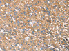 The image on the left is immunohistochemistry of paraffin-embedded Human liver cancer tissue using CSB-PA925916 (RNASET2 Antibody) at dilution 1/30, on the right is treated with fusion protein. (Original magnification: ×200)