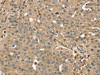 The image on the left is immunohistochemistry of paraffin-embedded Human breast cancer tissue using CSB-PA904655 (RNH1 Antibody) at dilution 1/40, on the right is treated with fusion protein. (Original magnification: ×200)
