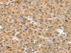 The image on the left is immunohistochemistry of paraffin-embedded Human liver cancer tissue using CSB-PA534045 (RNH1 Antibody) at dilution 1/30, on the right is treated with fusion protein. (Original magnification: ×200)