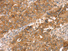 The image on the left is immunohistochemistry of paraffin-embedded Human breast cancer tissue using CSB-PA287378 (PDLIM4 Antibody) at dilution 1/30, on the right is treated with fusion protein. (Original magnification: ×200)