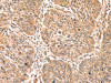 The image on the left is immunohistochemistry of paraffin-embedded Human lung cancer tissue using CSB-PA202328 (PDLIM4 Antibody) at dilution 1/40, on the right is treated with fusion protein. (Original magnification: ×200)