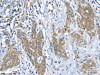 The image on the left is immunohistochemistry of paraffin-embedded Human cervical cancer tissue using CSB-PA657435 (DSTYK Antibody) at dilution 1/40, on the right is treated with fusion protein. (Original magnification: ×200)