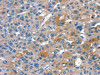 The image on the left is immunohistochemistry of paraffin-embedded Human liver cancer tissue using CSB-PA135946 (RNF7 Antibody) at dilution 1/20, on the right is treated with fusion protein. (Original magnification: ×200)