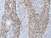 The image on the left is immunohistochemistry of paraffin-embedded Human esophagus cancer tissue using CSB-PA942697 (RNF20 Antibody) at dilution 1/20, on the right is treated with fusion protein. (Original magnification: ×200)