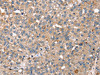 The image on the left is immunohistochemistry of paraffin-embedded Human breast cancer tissue using CSB-PA134767 (RNF11 Antibody) at dilution 1/40, on the right is treated with fusion protein. (Original magnification: ×200)