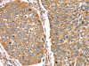 The image on the left is immunohistochemistry of paraffin-embedded Human lung cancer tissue using CSB-PA134767 (RNF11 Antibody) at dilution 1/40, on the right is treated with fusion protein. (Original magnification: ×200)