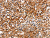 The image on the left is immunohistochemistry of paraffin-embedded Human prostate cancer tissue using CSB-PA992772 (TRIM69 Antibody) at dilution 1/40, on the right is treated with fusion protein. (Original magnification: ×200)