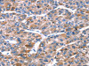 The image on the left is immunohistochemistry of paraffin-embedded Human liver cancer tissue using CSB-PA109226 (RPL11 Antibody) at dilution 1/20, on the right is treated with fusion protein. (Original magnification: ×200)