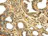The image on the left is immunohistochemistry of paraffin-embedded Human thyroid cancer tissue using CSB-PA084207 (RPS3 Antibody) at dilution 1/25, on the right is treated with fusion protein. (Original magnification: ×200)