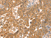 The image on the left is immunohistochemistry of paraffin-embedded Human breast cancer tissue using CSB-PA121989 (RPS6KA1 Antibody) at dilution 1/30, on the right is treated with fusion protein. (Original magnification: ×200)