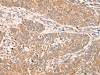 The image on the left is immunohistochemistry of paraffin-embedded Human lung cancer tissue using CSB-PA121989 (RPS6KA1 Antibody) at dilution 1/30, on the right is treated with fusion protein. (Original magnification: ×200)