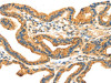 The image on the left is immunohistochemistry of paraffin-embedded Human thyroid cancer tissue using CSB-PA022239 (RRAGA Antibody) at dilution 1/30, on the right is treated with fusion protein. (Original magnification: ×200)