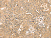 The image on the left is immunohistochemistry of paraffin-embedded Human breast cancer tissue using CSB-PA781114 (ATOX1 Antibody) at dilution 1/30, on the right is treated with fusion protein. (Original magnification: ×200)