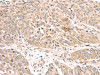 The image on the left is immunohistochemistry of paraffin-embedded Human lung cancer tissue using CSB-PA781114 (ATOX1 Antibody) at dilution 1/30, on the right is treated with fusion protein. (Original magnification: ×200)