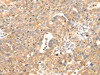 The image on the left is immunohistochemistry of paraffin-embedded Human breast cancer tissue using CSB-PA062822 (S100A12 Antibody) at dilution 1/45, on the right is treated with fusion protein. (Original magnification: ×200)