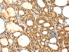 The image on the left is immunohistochemistry of paraffin-embedded Human thyroid cancer tissue using CSB-PA930566 (SAMD3 Antibody) at dilution 1/25, on the right is treated with fusion protein. (Original magnification: ×200)