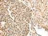 The image on the left is immunohistochemistry of paraffin-embedded Human esophagus cancer tissue using CSB-PA930566 (SAMD3 Antibody) at dilution 1/25, on the right is treated with fusion protein. (Original magnification: ×200)