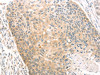 The image on the left is immunohistochemistry of paraffin-embedded Human esophagus cancer tissue using CSB-PA277938 (SCAP Antibody) at dilution 1/20, on the right is treated with fusion protein. (Original magnification: ×200)
