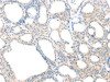 The image on the left is immunohistochemistry of paraffin-embedded Human thyroid cancer tissue using CSB-PA180985 (SCAP Antibody) at dilution 1/20, on the right is treated with fusion protein. (Original magnification: ×200)