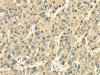 The image on the left is immunohistochemistry of paraffin-embedded Human liver cancer tissue using CSB-PA036156 (SDF4 Antibody) at dilution 1/35, on the right is treated with fusion protein. (Original magnification: ×200) The image on the left is immunohistochemistry of paraffin-embedded Human liver cancer tissue using CSB-PA036156 (SDF4 Antibody) at dilution 1/35, on the right is treated with fusion protein. (Original magnification: ×200)