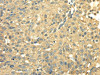The image on the left is immunohistochemistry of paraffin-embedded Human breast cancer tissue using CSB-PA177790 (SDHA Antibody) at dilution 1/40, on the right is treated with fusion protein. (Original magnification: ×200)
