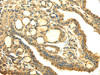 The image on the left is immunohistochemistry of paraffin-embedded Human thyroid cancer tissue using CSB-PA177790 (SDHA Antibody) at dilution 1/40, on the right is treated with fusion protein. (Original magnification: ×200)