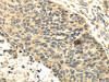 The image on the left is immunohistochemistry of paraffin-embedded Human esophagus cancer tissue using CSB-PA679493 (SEMA4F Antibody) at dilution 1/35, on the right is treated with fusion protein. (Original magnification: ×200)