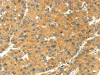 The image on the left is immunohistochemistry of paraffin-embedded Human liver cancer tissue using CSB-PA077271 (SEMA4C Antibody) at dilution 1/20, on the right is treated with fusion protein. (Original magnification: ×200)