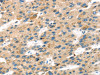 The image on the left is immunohistochemistry of paraffin-embedded Human liver cancer tissue using CSB-PA951733 (SENP8 Antibody) at dilution 1/40, on the right is treated with fusion protein. (Original magnification: ×200)