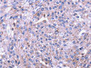 The image on the left is immunohistochemistry of paraffin-embedded Human breast cancer tissue using CSB-PA692718 (SENP2 Antibody) at dilution 1/20, on the right is treated with fusion protein. (Original magnification: ×200) The image on the left is immunohistochemistry of paraffin-embedded Human breast cancer tissue using CSB-PA692718 (SENP2 Antibody) at dilution 1/20, on the right is treated with fusion protein. (Original magnification: ×200)