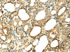 The image on the left is immunohistochemistry of paraffin-embedded Human thyroid cancer tissue using CSB-PA824741 (SERPINA12 Antibody) at dilution 1/40, on the right is treated with fusion protein. (Original magnification: ×200)