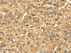 The image on the left is immunohistochemistry of paraffin-embedded Human liver cancer tissue using CSB-PA198452 (SERPINB6 Antibody) at dilution 1/35, on the right is treated with fusion protein. (Original magnification: ×200)