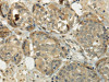 The image on the left is immunohistochemistry of paraffin-embedded Human breast cancer tissue using CSB-PA490759 (SIAH1 Antibody) at dilution 1/35, on the right is treated with fusion protein. (Original magnification: ×200)