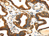 The image on the left is immunohistochemistry of paraffin-embedded Human thyroid cancer tissue using CSB-PA590348 (SLC25A26 Antibody) at dilution 1/30, on the right is treated with fusion protein. (Original magnification: ×200)