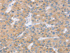 The image on the left is immunohistochemistry of paraffin-embedded Human liver cancer tissue using CSB-PA143150 (SLC27A2 Antibody) at dilution 1/20, on the right is treated with fusion protein. (Original magnification: ×200)