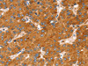 The image on the left is immunohistochemistry of paraffin-embedded Human liver cancer tissue using CSB-PA577196 (SLC27A2 Antibody) at dilution 1/20, on the right is treated with fusion protein. (Original magnification: ×200)
