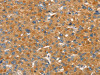 The image on the left is immunohistochemistry of paraffin-embedded Human liver cancer tissue using CSB-PA200109 (SLC29A4 Antibody) at dilution 1/20, on the right is treated with fusion protein. (Original magnification: ×200)