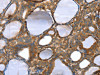 The image on the left is immunohistochemistry of paraffin-embedded Human thyroid cancer tissue using CSB-PA180088 (TAGLN Antibody) at dilution 1/30, on the right is treated with fusion protein. (Original magnification: ×200)