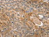 The image on the left is immunohistochemistry of paraffin-embedded Human esophagus cancer tissue using CSB-PA909917 (TAGLN Antibody) at dilution 1/20, on the right is treated with fusion protein. (Original magnification: ×200)
