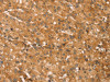 The image on the left is immunohistochemistry of paraffin-embedded Human liver cancer tissue using CSB-PA494754 (SNAP29 Antibody) at dilution 1/45, on the right is treated with fusion protein. (Original magnification: ×200)