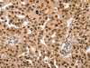 The image on the left is immunohistochemistry of paraffin-embedded Human breast cancer tissue using CSB-PA062373 (SMARCB1 Antibody) at dilution 1/30, on the right is treated with fusion protein. (Original magnification: ×200)