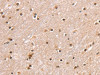 The image on the left is immunohistochemistry of paraffin-embedded Human brain tissue using CSB-PA062373 (SMARCB1 Antibody) at dilution 1/30, on the right is treated with fusion protein. (Original magnification: ×200)