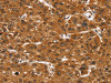 The image on the left is immunohistochemistry of paraffin-embedded Human liver cancer tissue using CSB-PA014989 (SMARCB1 Antibody) at dilution 1/35, on the right is treated with fusion protein. (Original magnification: ×200)